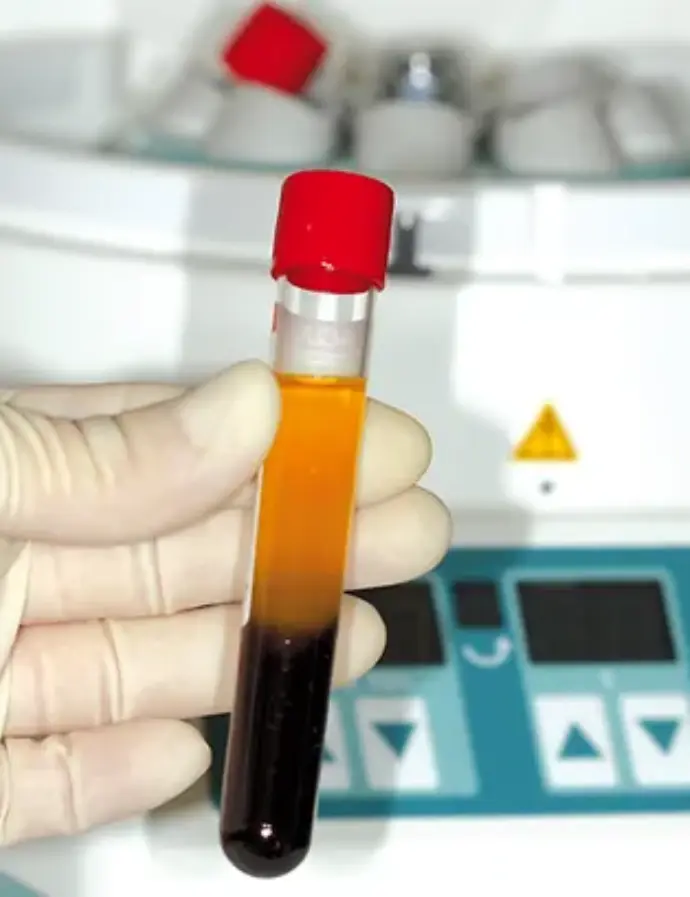 L-PRF™ is a 3-D autogenous combination of Platelet Rich Fibrin derived from the patient’s blood.