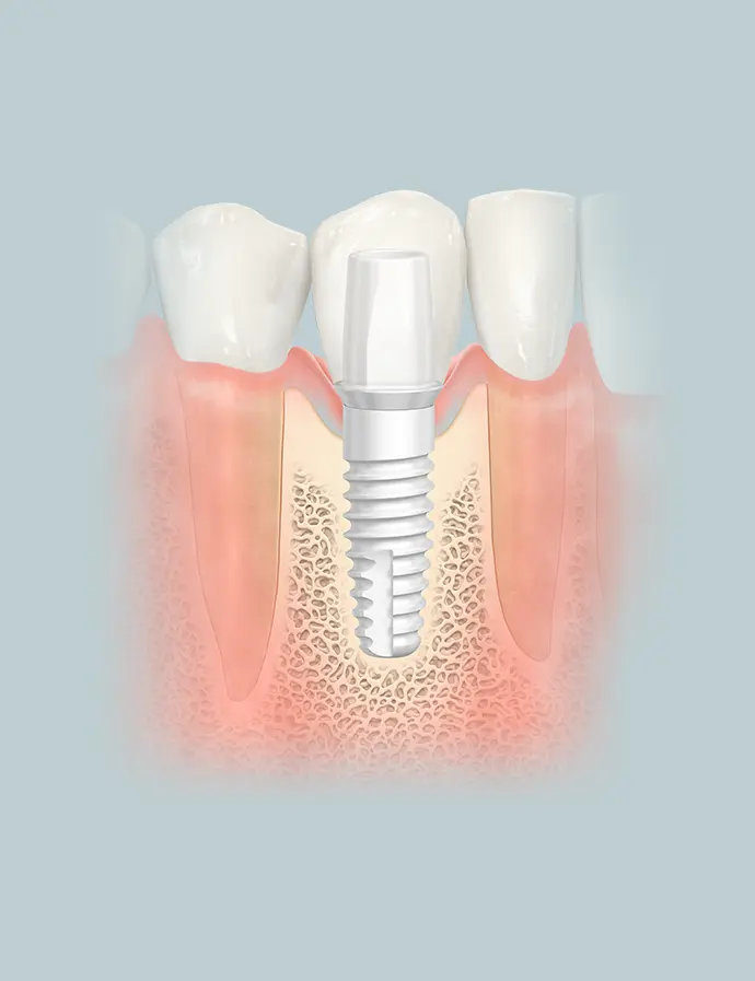 While titanium is widely used, it is not without drawbacks. As a metal, it is prone to corrosion, and some individuals may have sensitivities or allergies to certain metals.